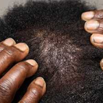 Alopecia Areata Explained: Signs, Oils That Help, and How to Regrow Hair